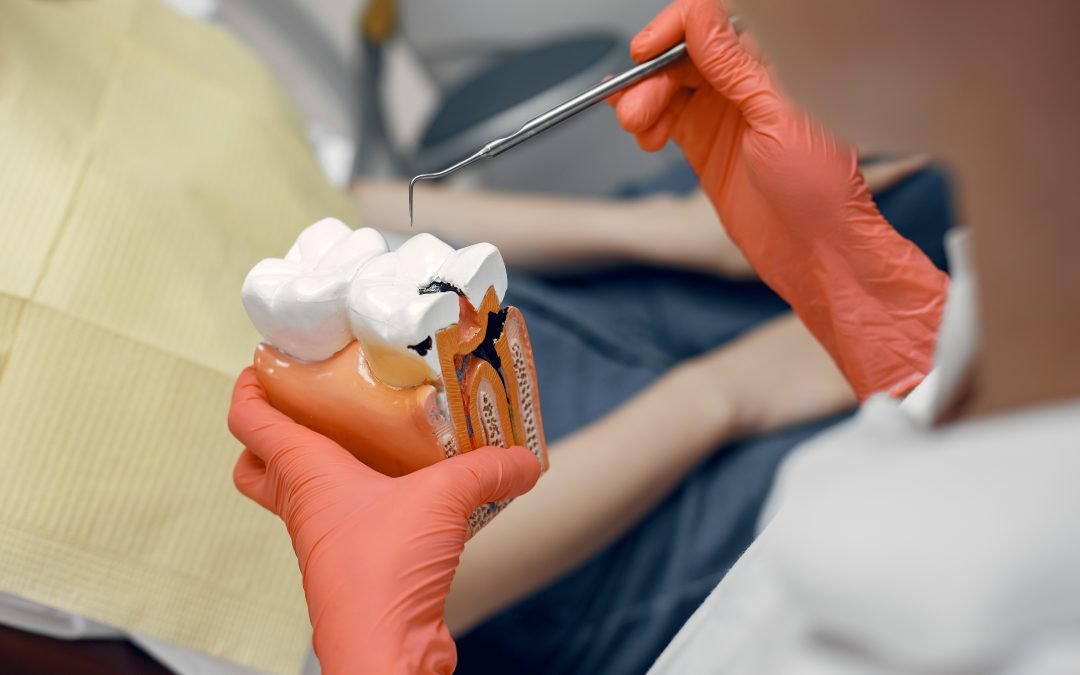 ¿Cómo se Forman las Caries en los Dientes? 5 Pasos