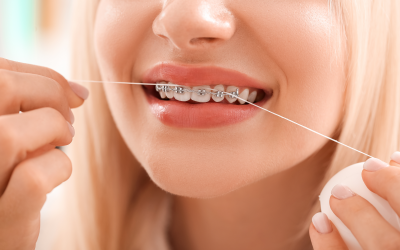 3 tipos de brackets: tips para elegir tu tratamiento de ortodoncia