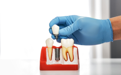 5 tipos de implantes dentales ¿Cuál es mejor?