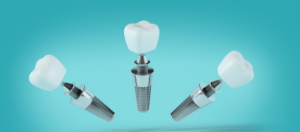 Implantes dentales Tenerife