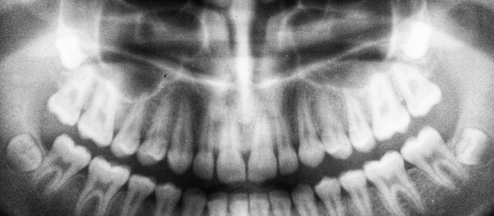 Radiografía panorámica dental (Ortopantomografía), fundamental para el diagnóstico de patologías de ATM y Dolor Orofacial.