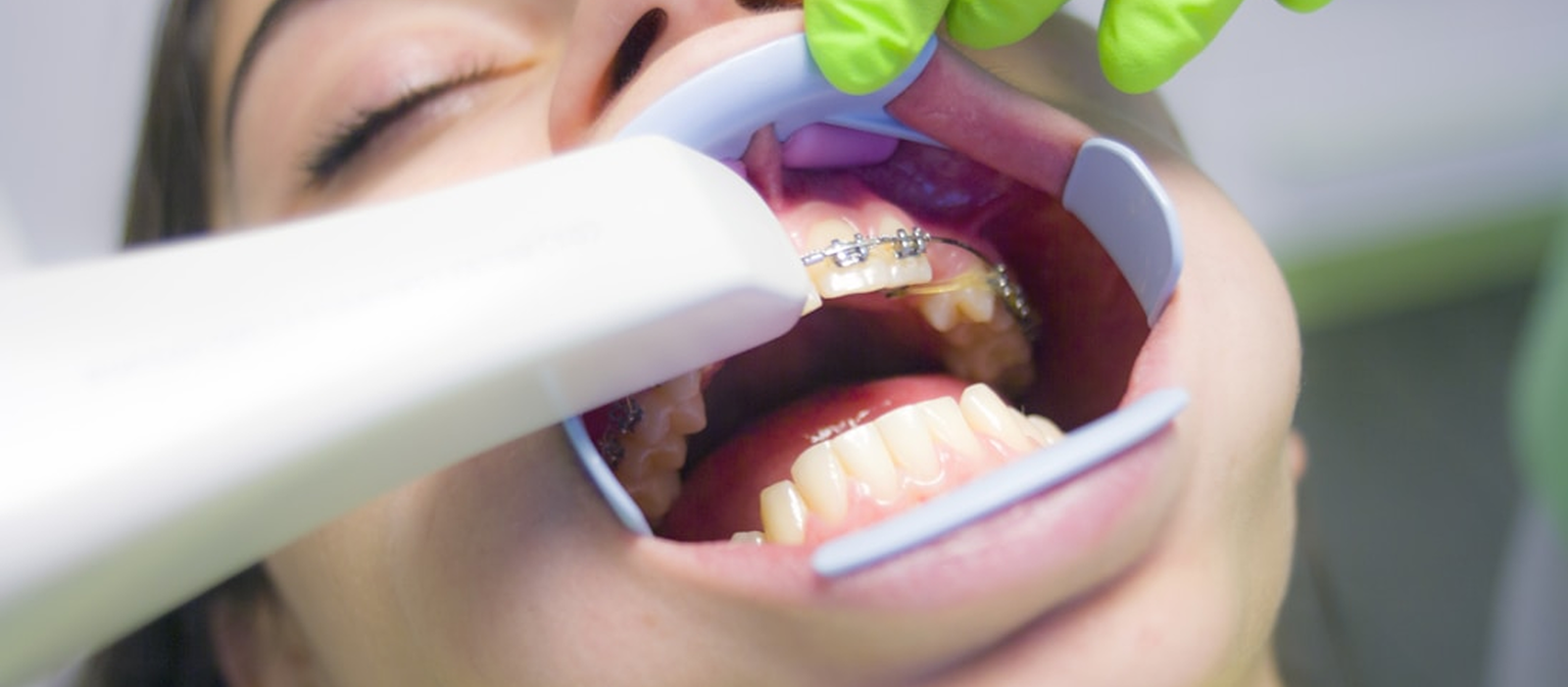 Primer plano de una sonrisa sana con encías rosadas y limpias, ilustrando el tratamiento de Periodoncia para la salud de las encías y soporte dental.