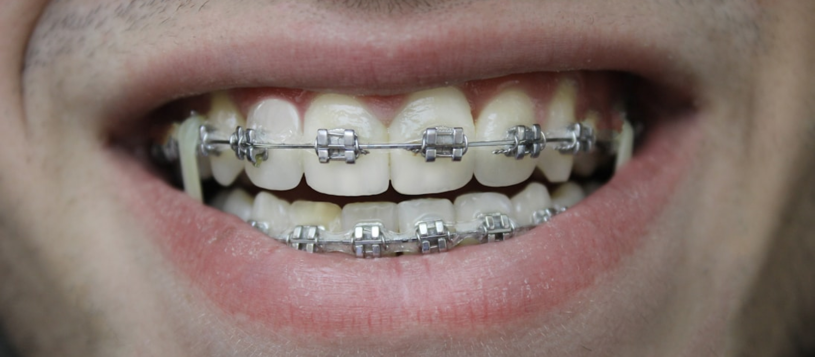 Primer plano de la sonrisa de un paciente con brackets metálicos, ilustrando el tratamiento de Ortodoncia para la alineación dental.