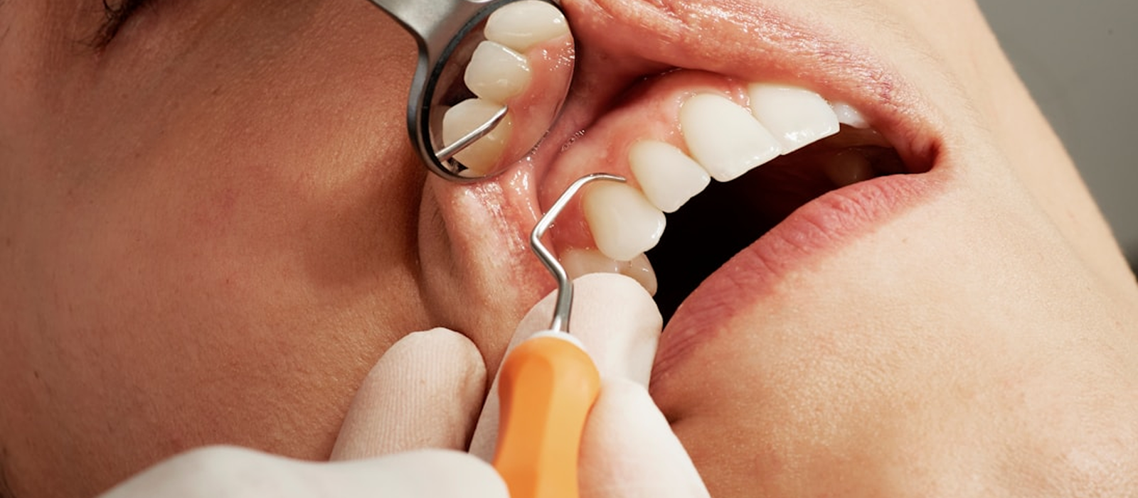 Primer plano de la boca de un paciente con brackets siendo examinado, ilustrando el diagnóstico y tratamiento de la Cirugía Bucal.