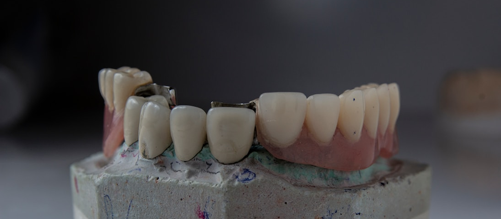 Primer plano de una prótesis dental fija o corona sobre un modelo de estudio, ilustrando el servicio de Prótesis e Implantoprótesis para reponer dientes ausentes.