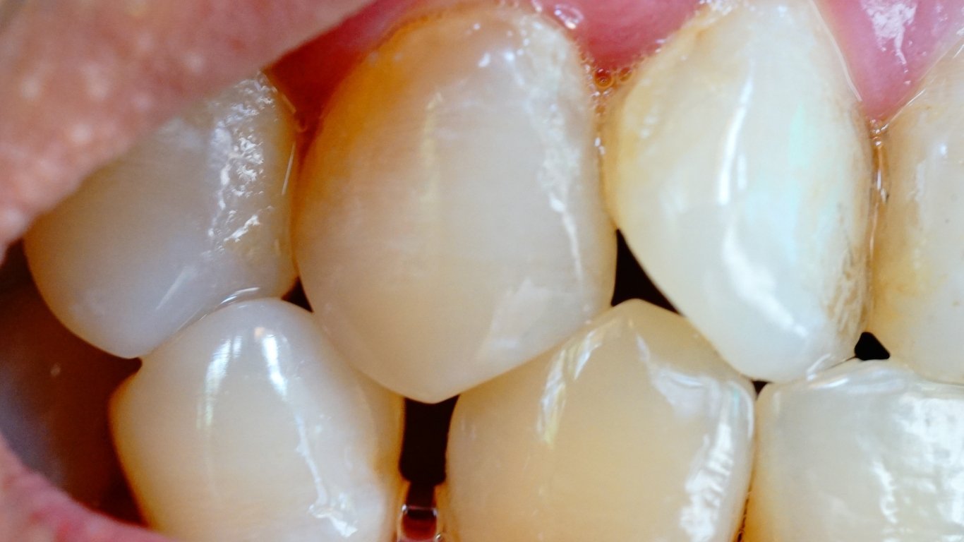 dientes-con-placa-bacteriana