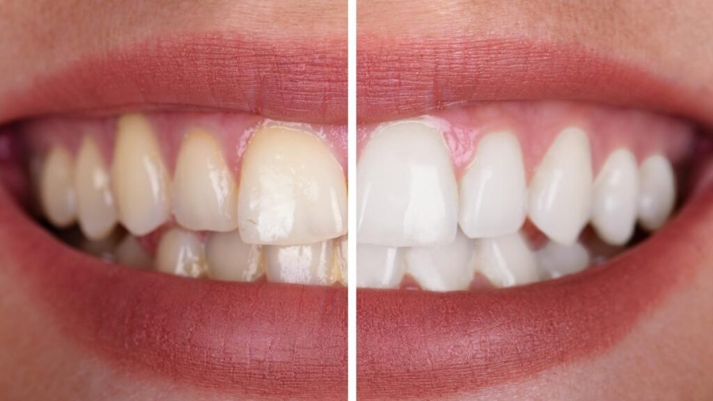 como-quitar-las-manchas-de-los-dientes