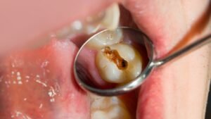 extraccion-muela-infectada